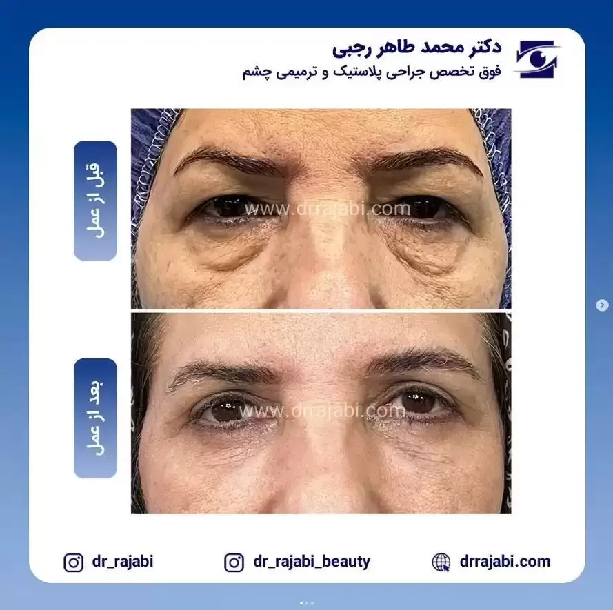 بلفاروپلاستی پلک بالا و پایین | دکتر رجبی